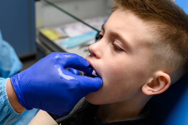 Kieferabdruck mit Silikon-Diagnosemodell, schiefe Zähne beim Kind, Besuch beim Kieferorthopäden. - Foto, Bild