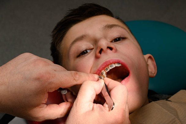 Oikomishoidon liimat ja kiinnittää hammasraudat ylähampaiden koulupoika, kohdistamalla hampaat hammasraudat, venyttely kuminauhat hammasraudat. - Valokuva, kuva