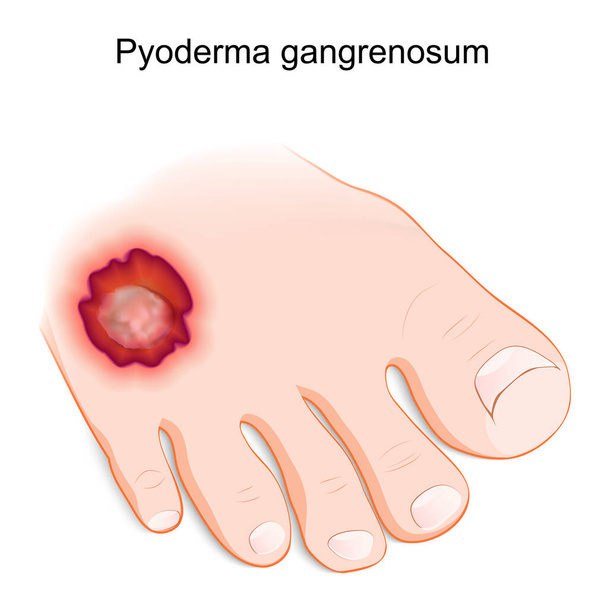 Pyoderma gangrenosum. inflammatory skin disease. Human's foot with a painful ulcer. vector illustration  - Vektör, Görsel