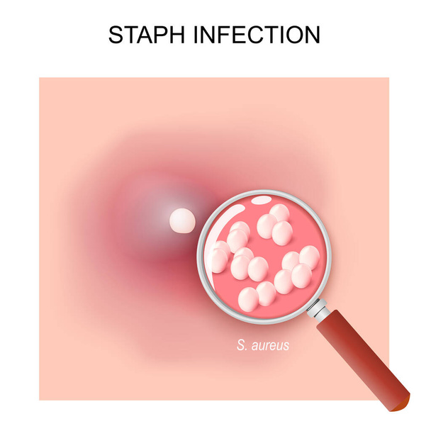 Інфекція стафілококів, викликана стафілококами. Зіткнення болючого червоного наконечника на шкірі. Акне. Staphylococcus aureus під збільшувальним склом. Приклад вектора - Вектор, зображення