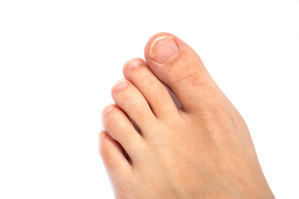 Fungus on the toe nail isolated on white background - Photo, Image