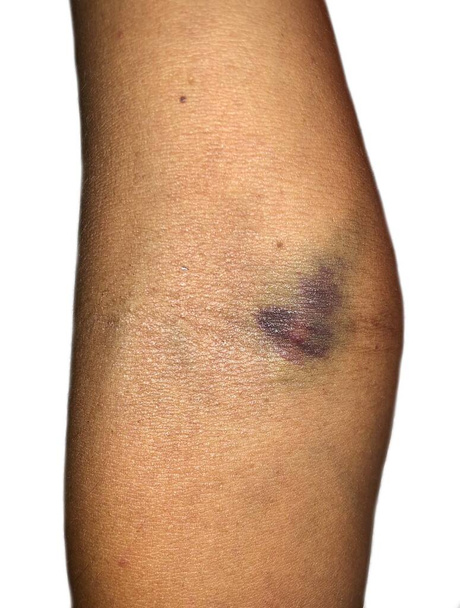 Bruises at elbow of Asian female patient. Intravenous needle injury. - Photo, Image