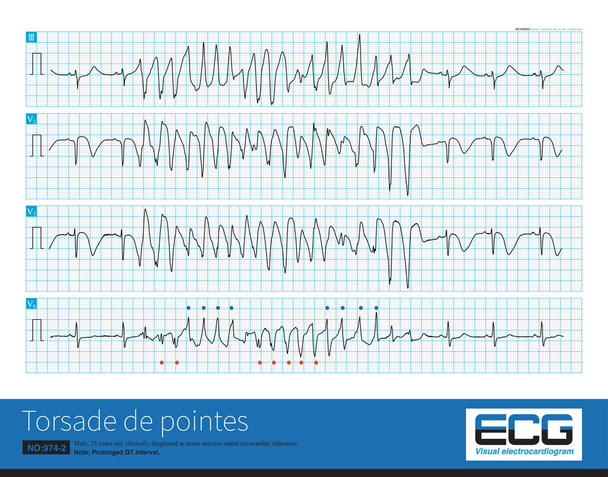 Male, 75 years old, clinically diagnosed as acute anterior septal myocardial infarction.It is best to use 12 leads to diagnose torsade de pointes because some leads may not have torsade characteristic - Photo, Image