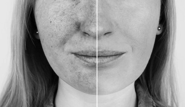 Rayos ultravioletas en la piel. Prueba de cremas protectoras. A la izquierda, la piel está desprotegida y las manchas de la exposición UV son visibles en ella. A la derecha, la piel está limpia bajo la protección de productos especiales. - Foto, imagen