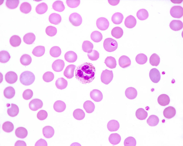 Мазок крови человека, где наблюдается нейтрофильный лейкоцит с токсичными грануляциями. Маленькие голубоватые точки среди красных кровяных телец тромбоциты. - Фото, изображение