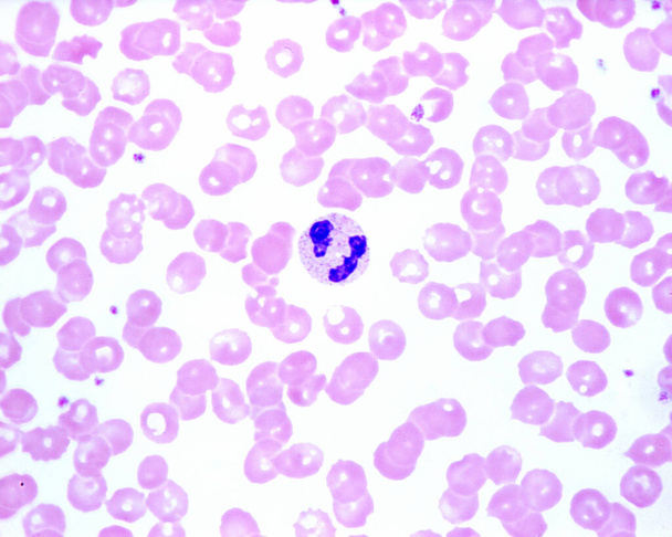 İnsan kanında nötrofil lökosit, çoklu bantlı çekirdekli (yukarı) ve polilobullu (aşağı) çekirdekli (yukarı) bir kan lekesi görülüyor. Kırmızı kan hücreleri arasındaki küçük mavimsi noktalar trombositlerdir.. - Fotoğraf, Görsel