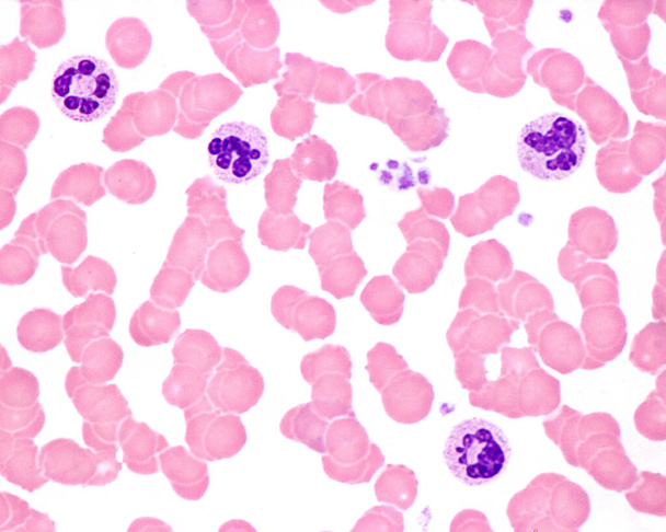Mancha de sangre humana. Leucocitosis en una infección aguda. Los leucocitos neutrófilos exhiben hipersegmentación nuclear y gránulos tóxicos en el citoplasma. Las plaquetas también se observan entre los glóbulos rojos. - Foto, Imagen
