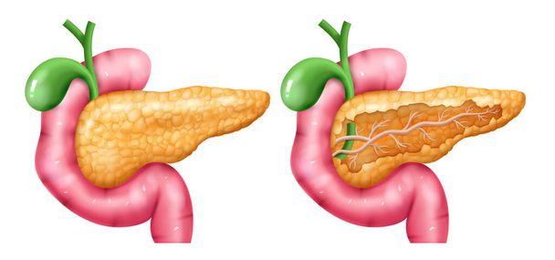 Set de iconos realistas del páncreas - Vector, Imagen