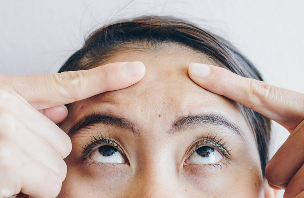 Detailní záběr ženy ukazující na její čelo s problémy s akné zarudnutí na kůži. Koncepce kožních problémů na ženské kůži. - Fotografie, Obrázek