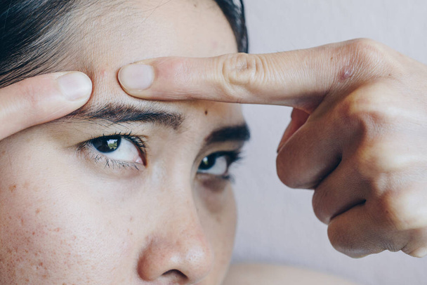 Vystřižený snímek asijské ženy, která se snaží mačkat akné zarudnutí na čele. Konceptuální problémy s akné a jizva na ženské kůži. - Fotografie, Obrázek
