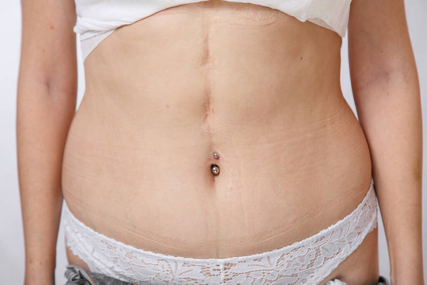 шрами кесаревого розтину і видалення селезінки на тілі молодої жінки. на білому ізольованому фоні
 - Фото, зображення