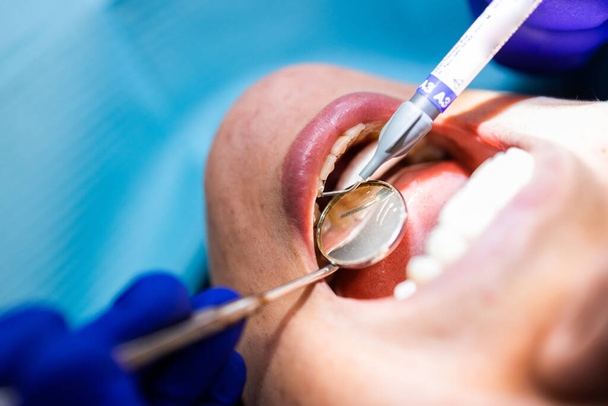 Onherkenbare tandarts doet een tandheelkundige vulling procedure om een vrouwelijke patiënt  - Foto, afbeelding
