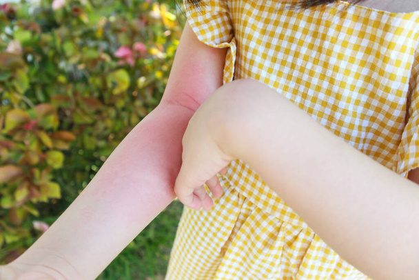 У маленькой девочки аллергия на сыпь на кожу и зуд на руке. - Фото, изображение