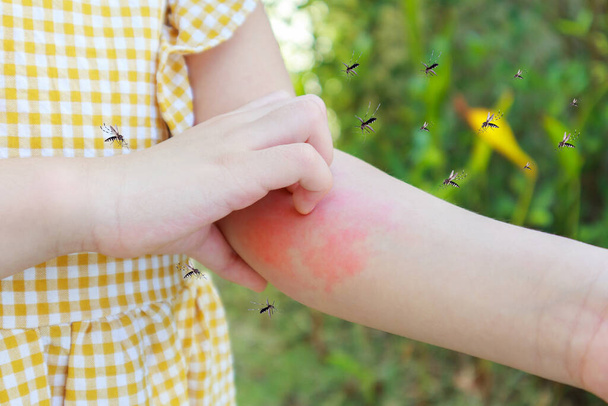 Küçük kızın cildinde isilik alerjisi var ve kolunda sivrisinek ısırığı yüzünden kaşıntı var. - Fotoğraf, Görsel