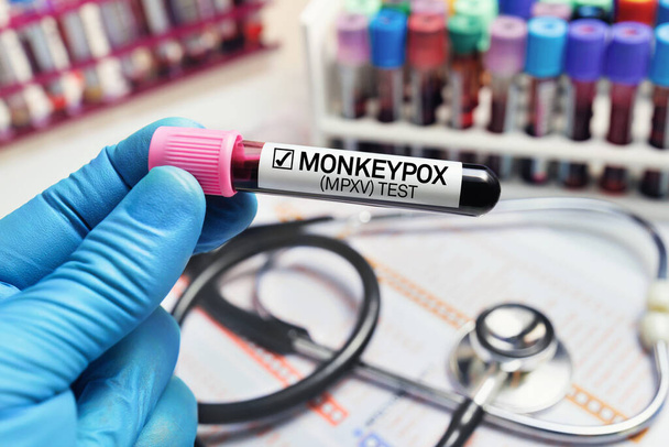 Chercheur tenant une éprouvette sanguine infectée par le virus de la variole du singe (MPXV). Médecin avec un échantillon de sang dans un tube diagnostiqué avec la variole du singe (MPXV) maladie - Photo, image