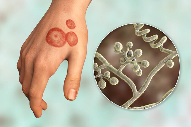 Pilzinfektion an einer menschlichen Hand. Ringwurm, Tinea manuum und Nahaufnahme von Dermatophytenpilzen Trichophyton mentagrophytes, 3D-Illustration - Foto, Bild