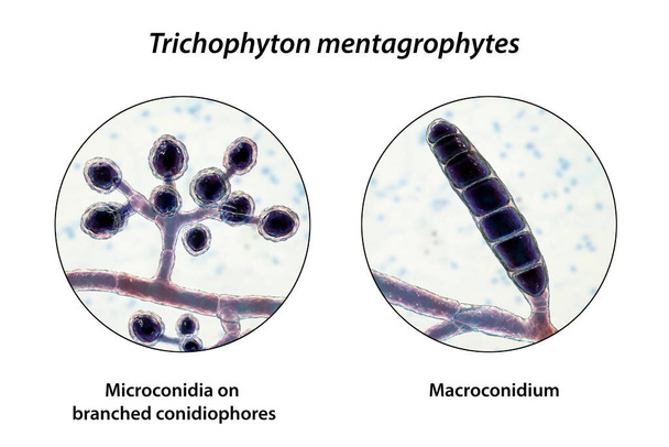 Champignons Trichophyton mentagrophytes, illustration 3D montrant des conidiophores ramifiés portant des microconidies sphériques, des macroconidies, des hyphes septés et spiraux. Causes teigne, infections des cheveux et des ongles - Photo, image