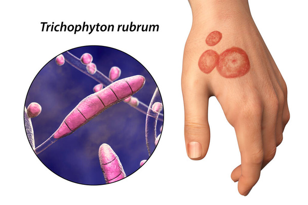 Gombás fertőzés egy férfi kezén. Tinea manuum és közelkép dermatophyte gombák Trichophyton rubrum, 3D illusztráció - Fotó, kép