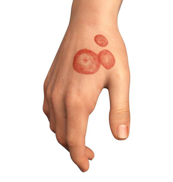 Infección fúngica en la mano de un hombre. Tinea manuum, ilustración 3D - Foto, Imagen
