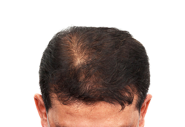 Male head with hair loss symptoms front side - Photo, Image