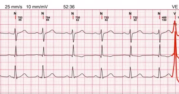 Eletrocardiograma, forma de onda do eletrocardiograma mostrando teste de exame - Filmagem, Vídeo