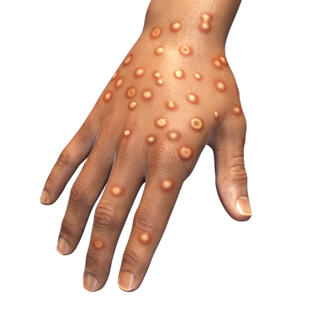 Hand eines Patienten mit Affenpockeninfektion, 3D-Illustration. Monkeypox ist ein zoonotisches Virus aus der Familie der Poxviridae, verursacht Monkeypox, eine pockenartige Krankheit - Foto, Bild