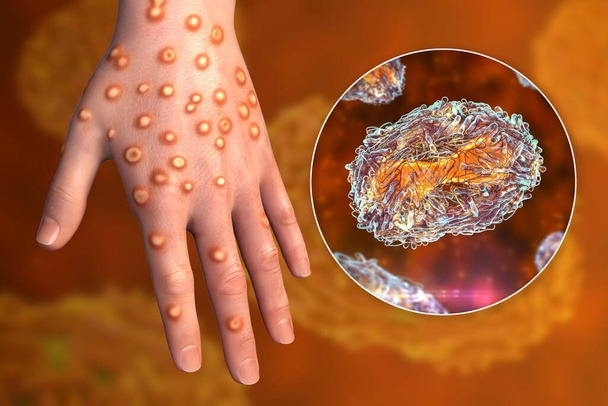 Hand of a patient with monkeypox infection, 3D illustration. Monkeypox is a zoonotic virus from Poxviridae family, causes monkeypox, a pox-like disease - Photo, Image