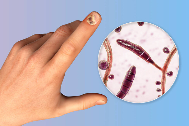 Mano humana con onicomicosis y vista de cerca de los hongos Trichopyton rubrum, uno de los agentes causantes de infecciones de uñas, ilustración 3D - Foto, Imagen
