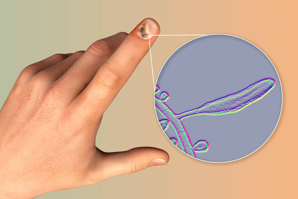 Main humaine avec onychomycose et vue rapprochée des champignons Trichopyton rubrum, l'un des agents responsables des infections des ongles, illustration 3D - Photo, image