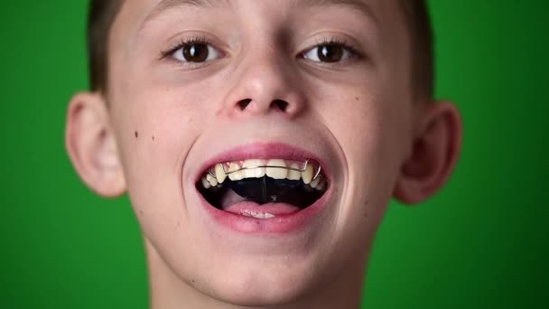 Стоматологическая пластина для выравнивания зубов во рту, ребенок носит зубную пластину для коррекции и выравнивания зубов. новый - Кадры, видео