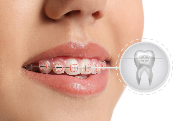 Mladá žena se zubními rovnátky na bílém pozadí, detailní záběr - Fotografie, Obrázek