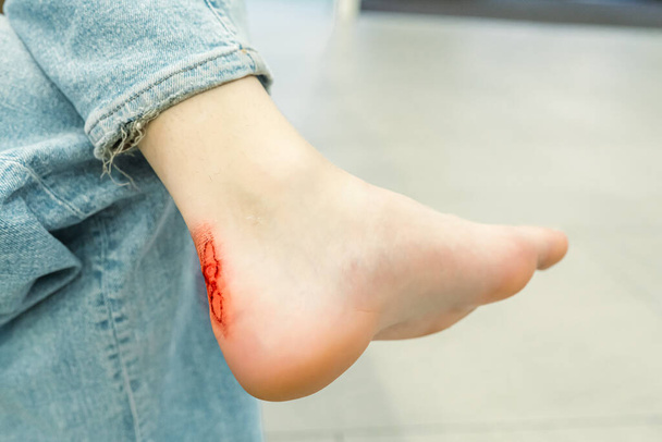 Επώδυνο τραύμα στο πόδι του κοριτσιού λόγω νέων παπουτσιών. Τρομερή πληγή στο τακούνι. Υγρό αιματηρή επώδυνη πληγή στο πόδι του παιδιού ή το κορίτσι. Παροχή ιατρικής περίθαλψης. Δέρμα σχισμένο σε αιματηρή πληγή στη φτέρνα - Φωτογραφία, εικόνα