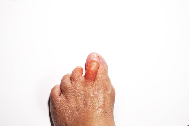 Сломанные, кривые пальцы ног пожилой женщины, вызванные несчастным случаем. - Фото, изображение