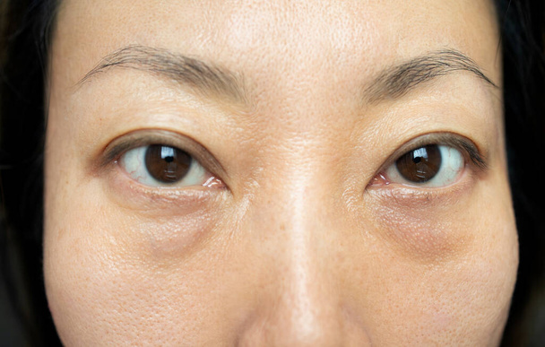 Ασιάτισσα γυναίκα έχει ρυτίδες στο πρόσωπο, μεγάλες σακούλες κάτω από τα μάτια τους. - Φωτογραφία, εικόνα