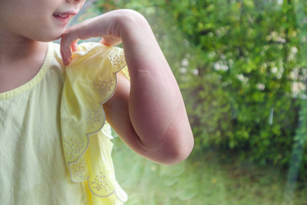Niña tiene erupción en la piel alergia y picazón en el brazo - Foto, Imagen