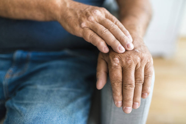 Elderly man suffering from psoriasis, closeup on hands - Foto, immagini