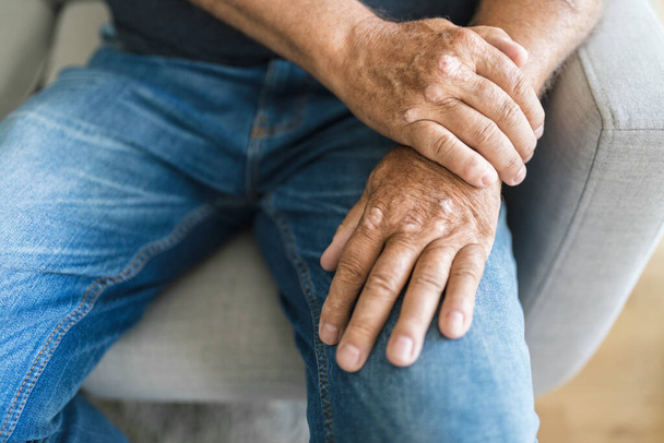 Elderly man suffering from psoriasis, closeup on hands - Foto, imagen