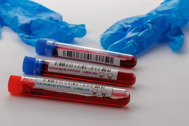 サルの水痘ウイルス陽性陰性のための血液検査でフラスコ - 写真・画像