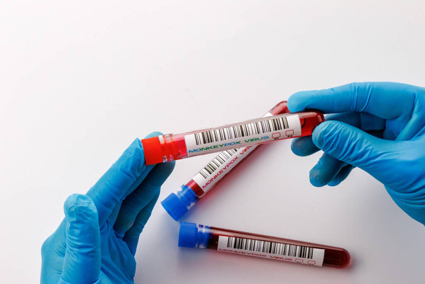 flacons avec analyses de sang pour le virus de la variole du singe positifs et négatifs - Photo, image
