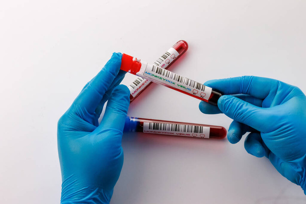 palloni con esami del sangue per il virus della varicella scimmia positivi e negativi - Foto, immagini
