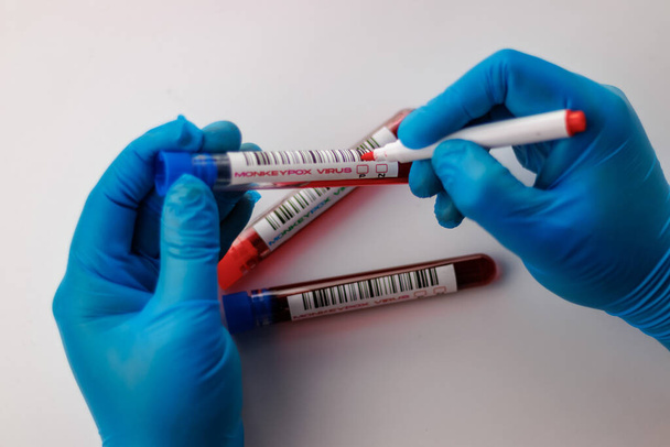 φιάλες με εξετάσεις αίματος για τον ιό της ευλογιάς των πιθήκων θετικές και αρνητικές - Φωτογραφία, εικόνα