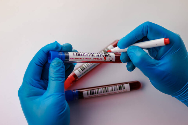 frascos con análisis de sangre para el virus de la viruela del mono positivos y negativos - Foto, imagen