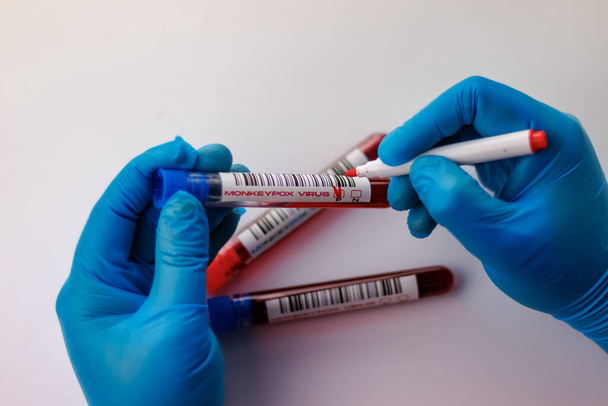 frascos com análises ao sangue para o vírus da varíola do macaco positivo e negativo - Foto, Imagem