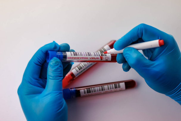 frascos con análisis de sangre para el virus de la viruela del mono positivos y negativos - Foto, Imagen