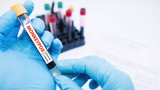 hand holding blood collection tubes and data sheet on monkeypox test positive results in laboratories. - Φωτογραφία, εικόνα
