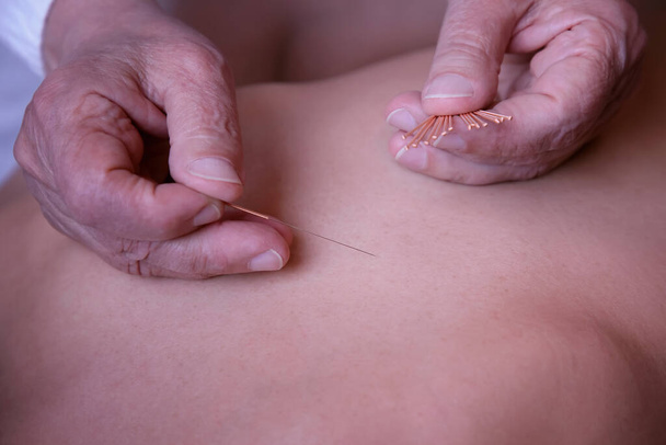 El médico acupunturista aplica una aguja en la piel del paciente acostado en la cama médica - Foto, imagen