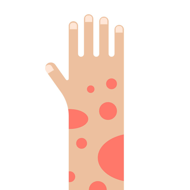 Рука с ранами от псориаза. Люди, страдающие от векторной иллюстрации псориаза. - Вектор,изображение