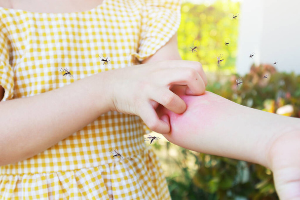 A kislánynak bőrkiütés allergiája van és viszket a karja a szúnyogcsípéstől. - Fotó, kép