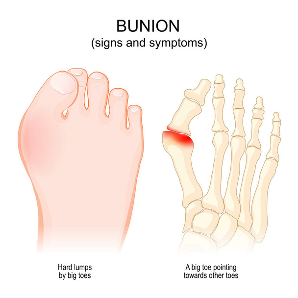 Gewerkschaften. Anzeichen und Symptome. Nahaufnahme des menschlichen Fußes mit Hallux abducto valgus. Vektorillustration - Vektor, Bild