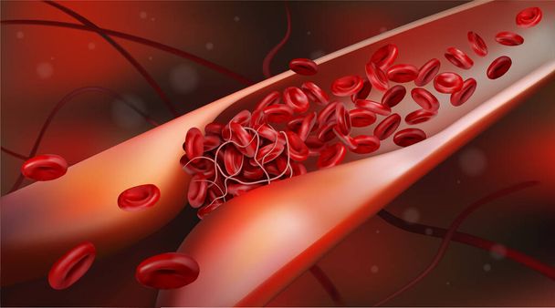 Vein with red blood cell flow and blood clot. 3d vector illustration - Vector, Image